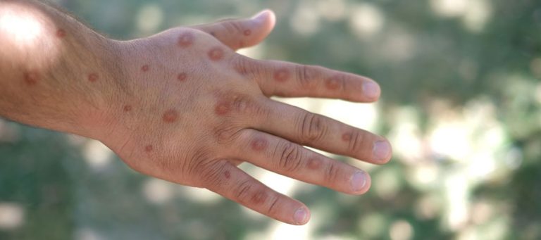monkey pox